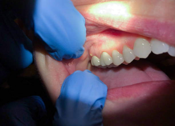Best Dentist for Tooth Abscess  in Wollochet, WA