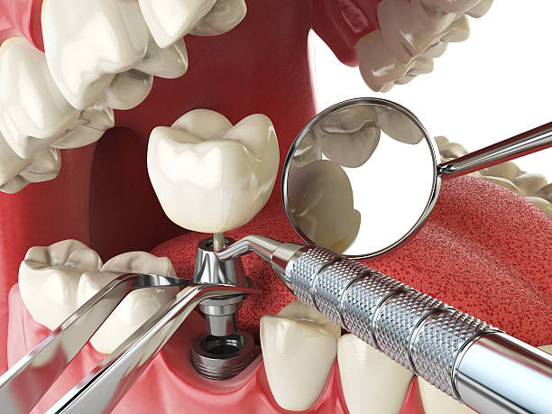 Best Knocked-Out Tooth Emergency  in Wollochet, WA